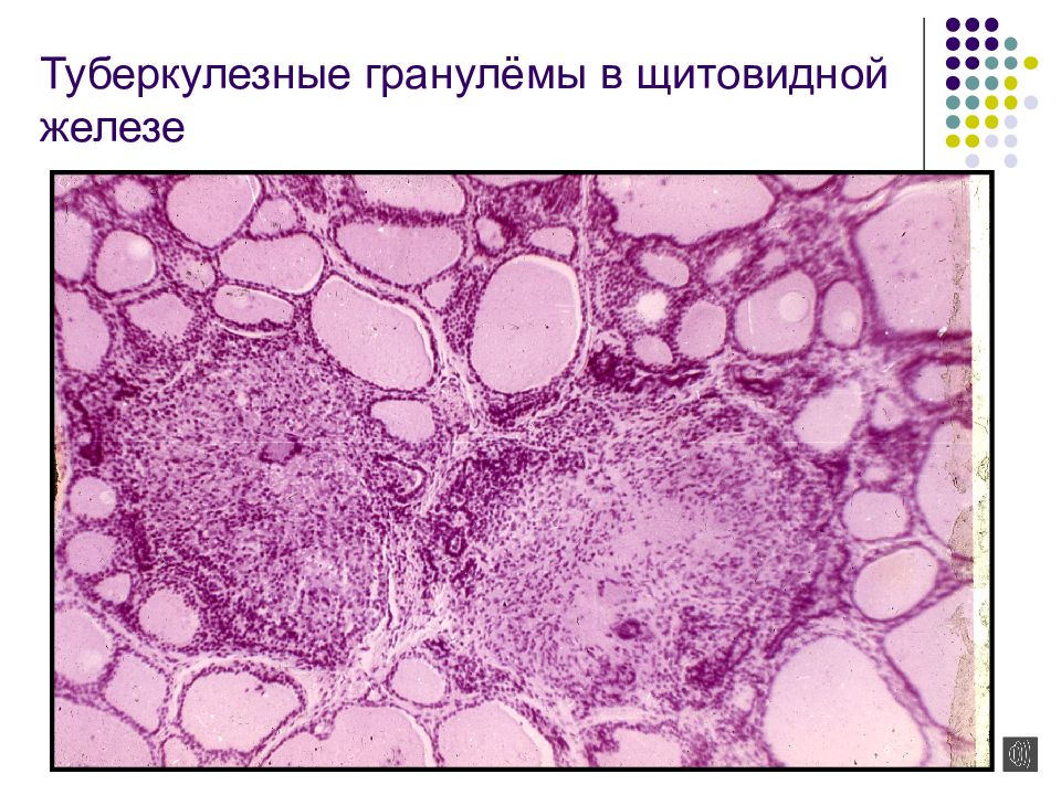 Туберкулезная гранулема рисунок