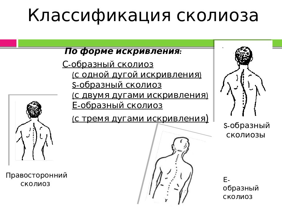 Презентация сколиоз у детей