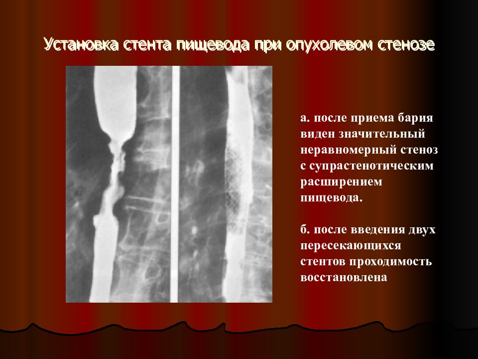 Расширение пищевода. Опухолевый стеноз пищевода. Установка стента в пищевод. Супрастенотическое расширение пищевода.