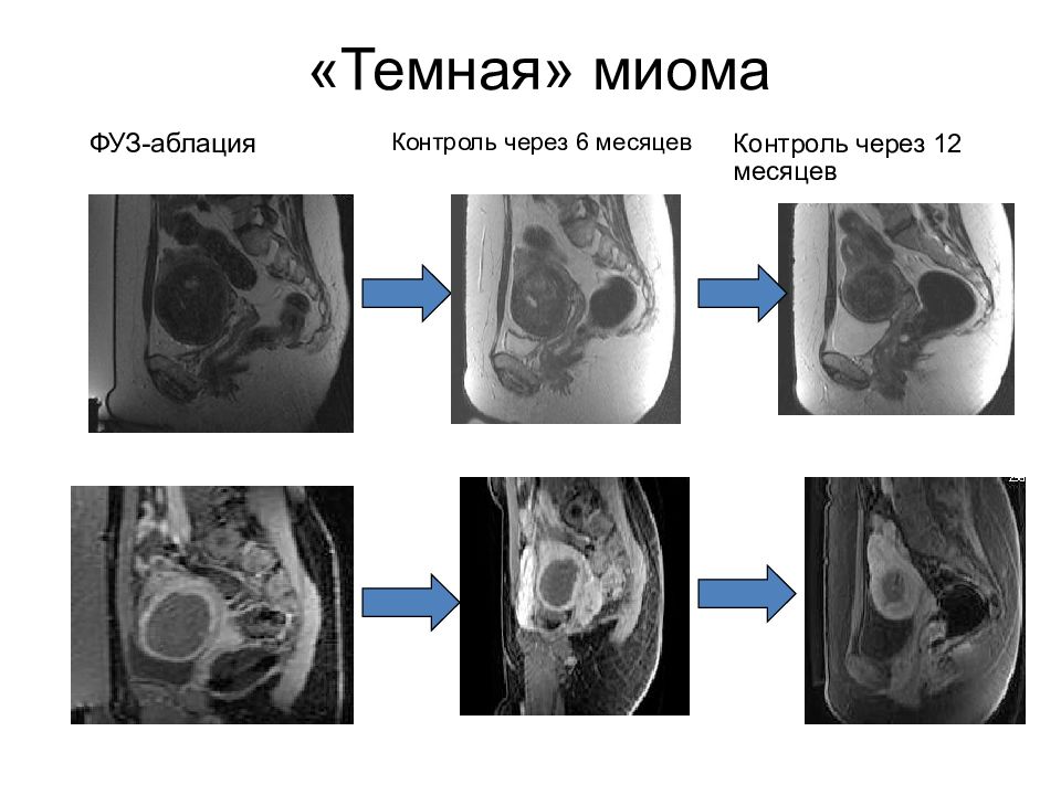 Миома матки мрт картина