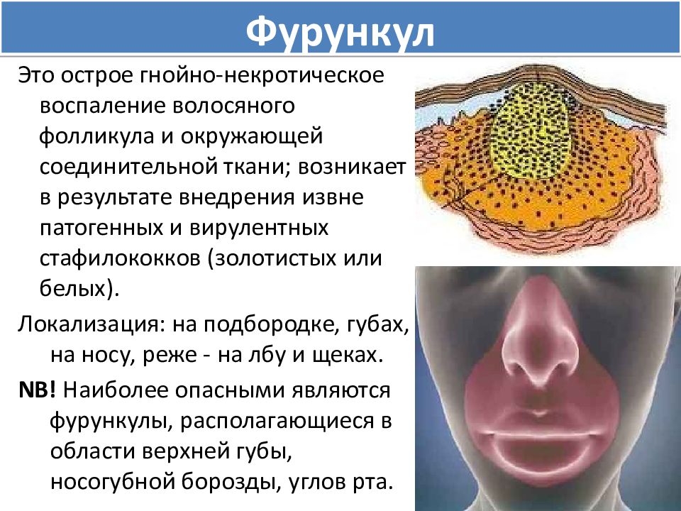 Воспалительные заболевания челюстно лицевой области презентация