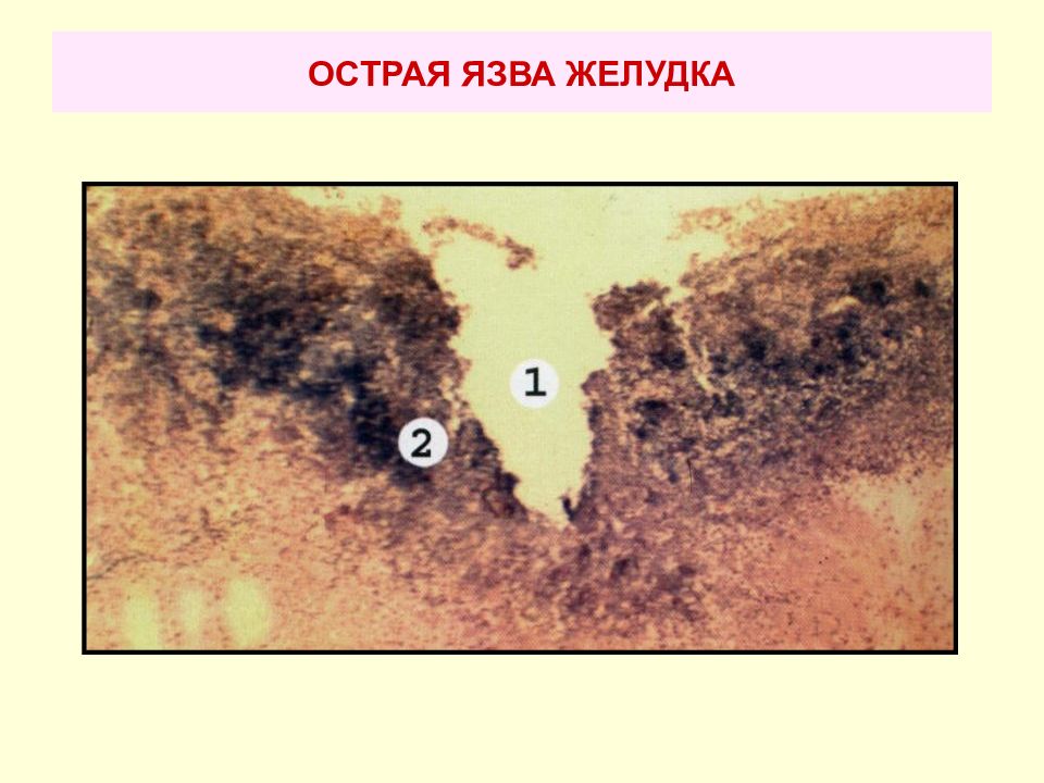 Хроническая язва желудка микропрепарат рисунок