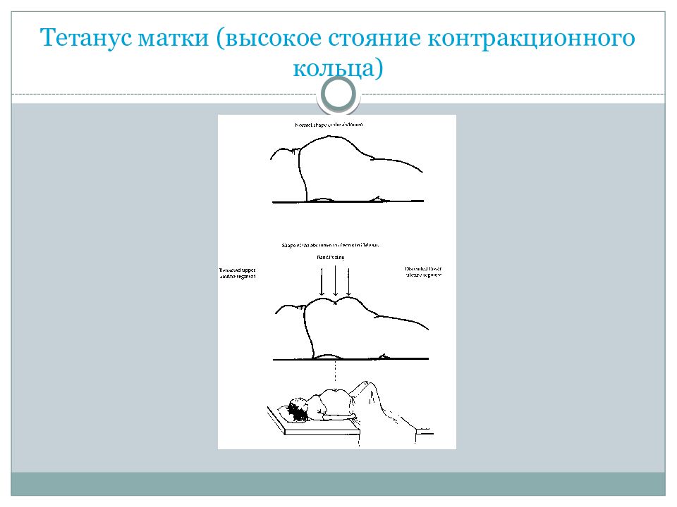 Контракционное кольцо в акушерстве. Высокое стояние контракционного кольца. Высокое расположение контракционного кольца. Тетанус матки. Тетанус матки Акушерство.