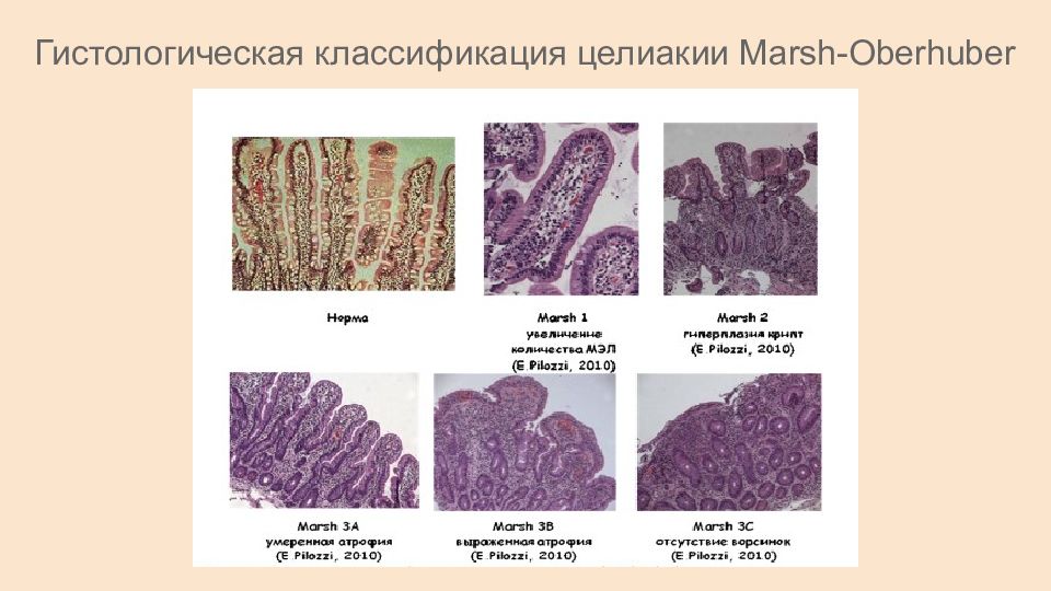 Целиакия презентация педиатрия