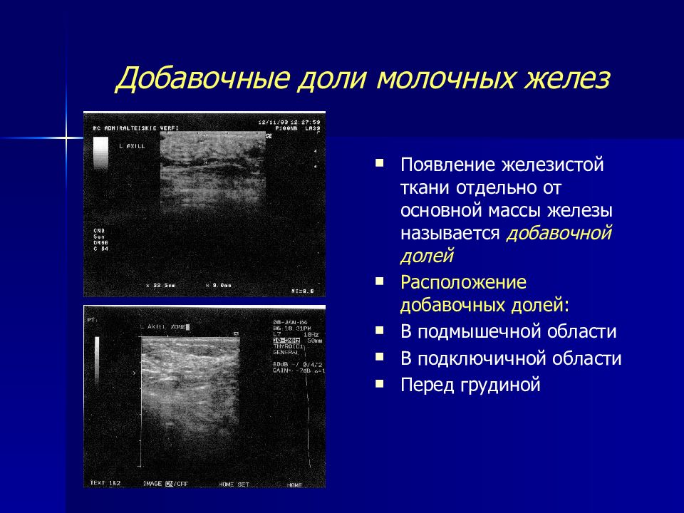 Молочная железа на узи молочной железы. Молочные железы УЗИ анатомия. Строение молочной железы по УЗИ. Типы строения молочной железы по УЗИ. Анатомия молочной железы на УЗИ.