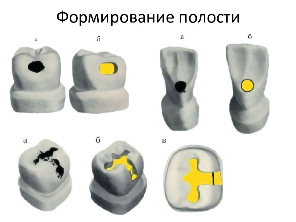 Классы препарирования по блэку. Классификация по Блеку. Препарирование кариозных полостей. Химико-механический метод препарирования кариозных полостей. Форма полости 3 класса по Блэку.