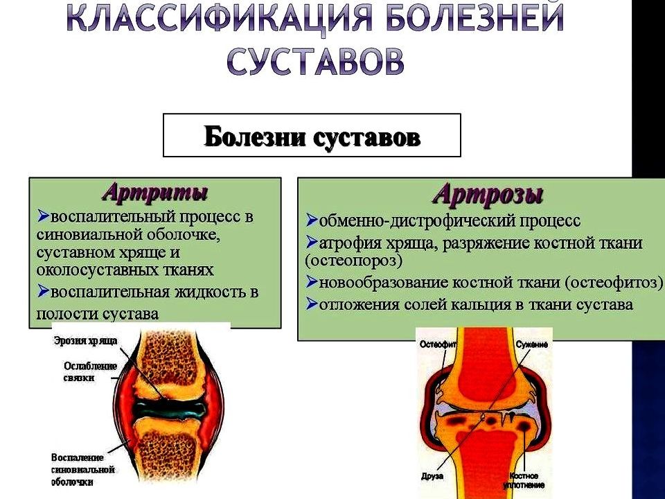 Нарушение суставов. Воспалительные заболевания суставов классификация. Заболевание суставов название. Хроническое заболевание суставов.