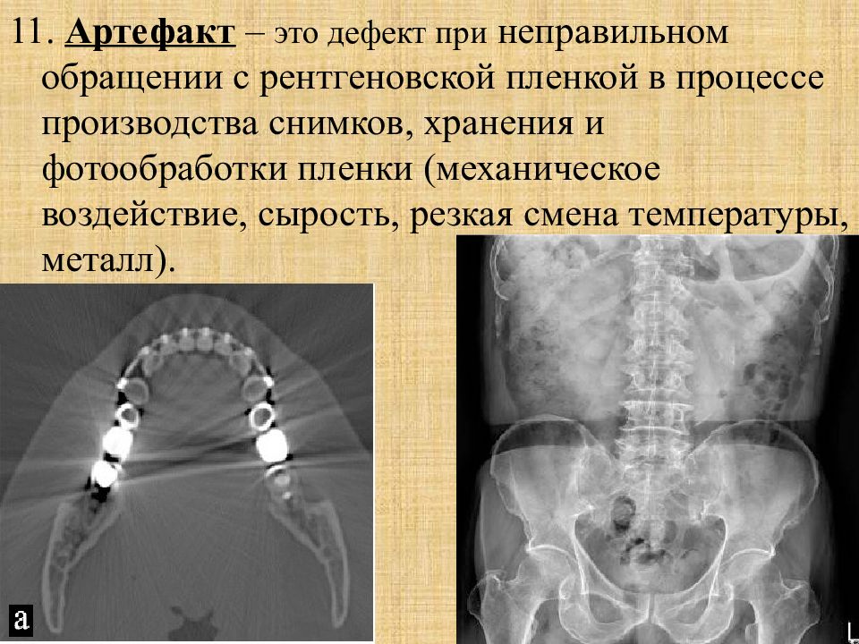 Артефакты мрт презентация