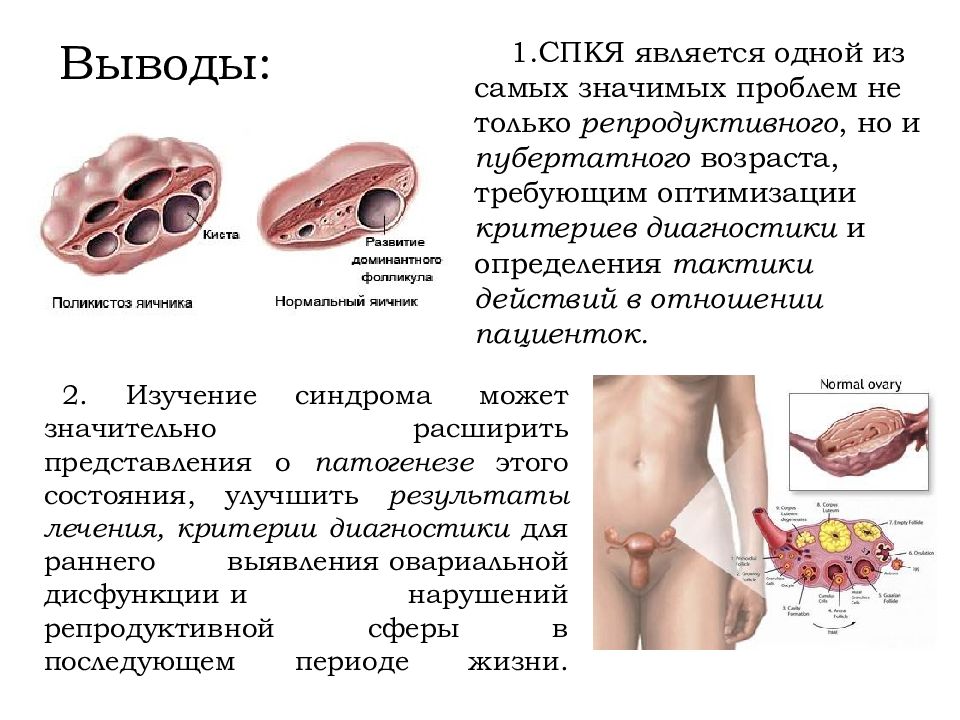 Спкя что это. Поликистоз яичников симптомы. Симптомы поликистоза яичников. Поликистозный синдром яичников. Дисфункция яичников у женщин.