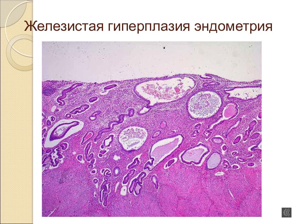 Железистая гиперплазия