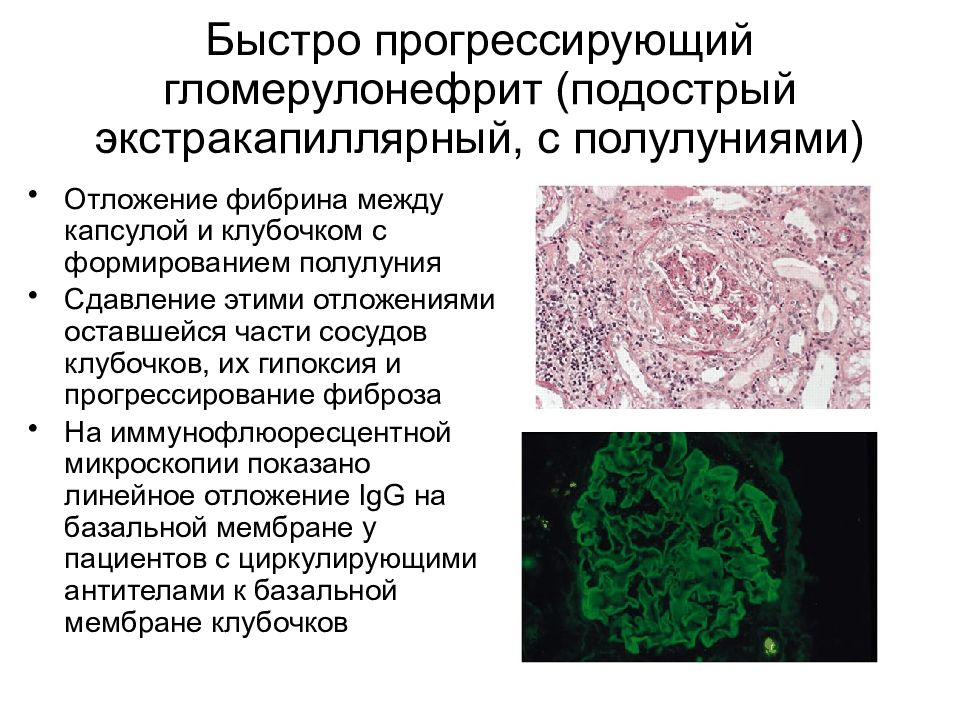 Хронический гломерулонефрит клиническая картина