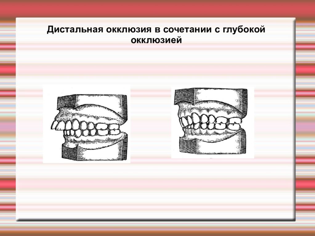 Внутренняя окклюзия. Дистальное смещение нижней челюсти. Дистальный прикус сбоку. Дистальная окклюзия профиль.