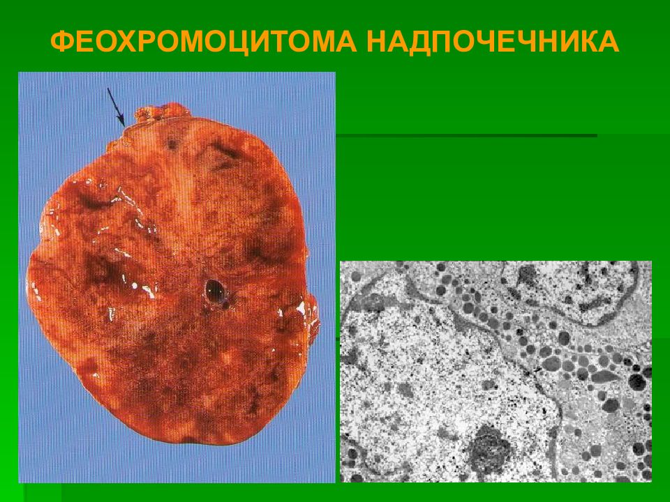 Клещевой энцефалит презентация патанатомия