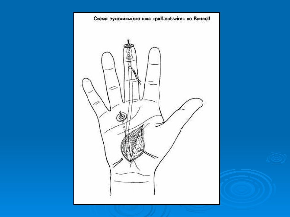 Презентация операции на сухожилиях
