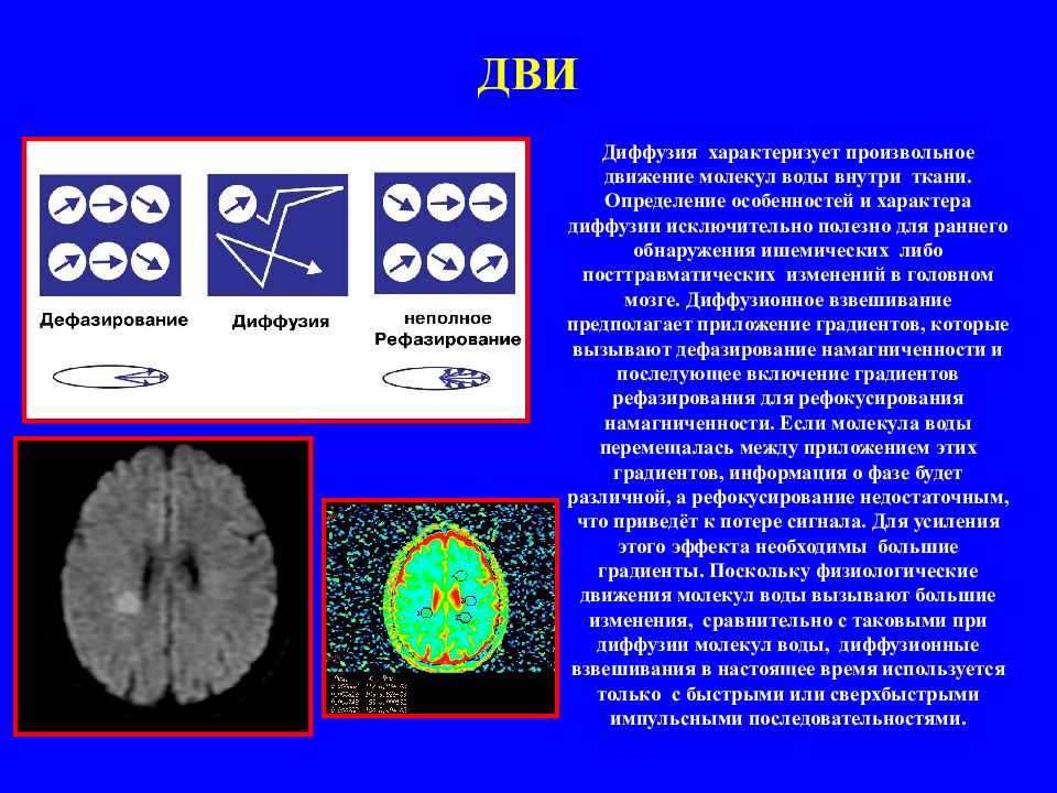 Есть дви. Магнитно-резонансная диффузия головного мозга. Ограничение диффузии на мрт. Диффузионная мрт. Мрт диффузия.