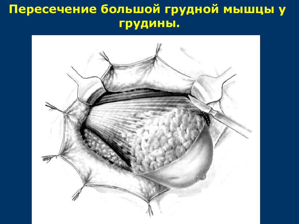 Операции топографическая анатомия. Хирургическая анатомия груди. Анатомия молочной железы хирургия. Хирургическая операция на строение грудных мышц. Атлас хирургических операций на молочной железе.