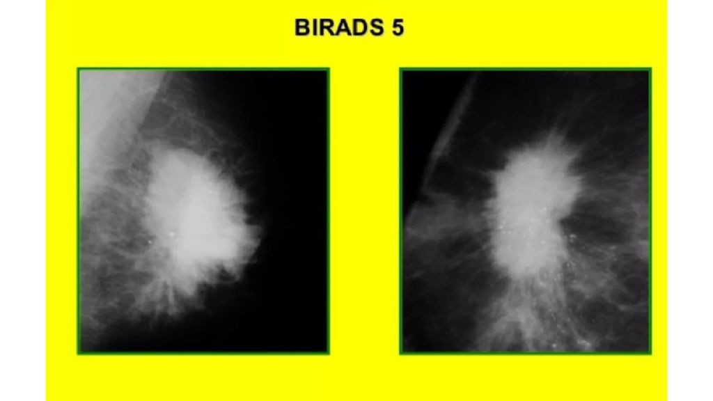 Bi rads md. Маммография молочной железы bi-rads. Bi rads молочной железы классификация УЗИ. Фиброзно кистозная мастопатия молочной железы bi-rads-4a. Bi-rads 2 молочной железы что это.
