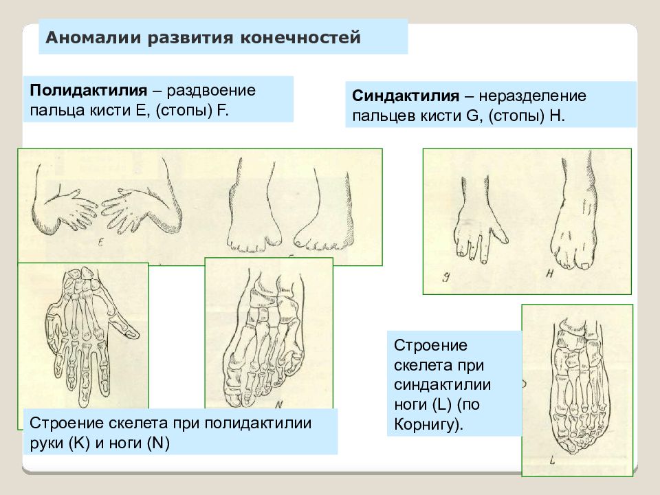 Аномалии развития верхних конечностей презентация