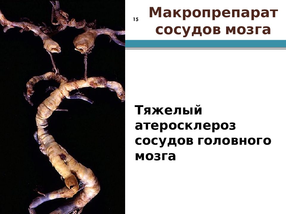 Атеросклероз аорты головного мозга. Атеросклероз артерий головного мозга макропрепарат. Атеросклероз сосудов головного мозга макропрепарат. Головной мозг макропрепарат. Атеросклероз аорты макропрепарат.