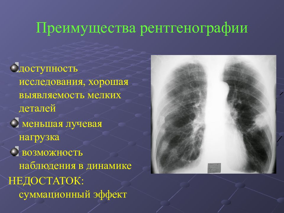 Диагностика легких. Рентгенодиагностика воспалительных заболеваний легких. Рентген заболевания легких лучевая диагностика. Заболевания легких рентгенология. Заболевания легких на рентгене.