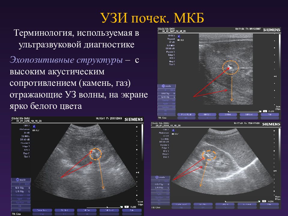 Узи увидеть. УЗИ анатомия почек измерение размеров по УЗИ. Мочекаменная болезнь УЗИ. Мкб на УЗИ почек. Мочекаменная болезнь УЗИ почек.