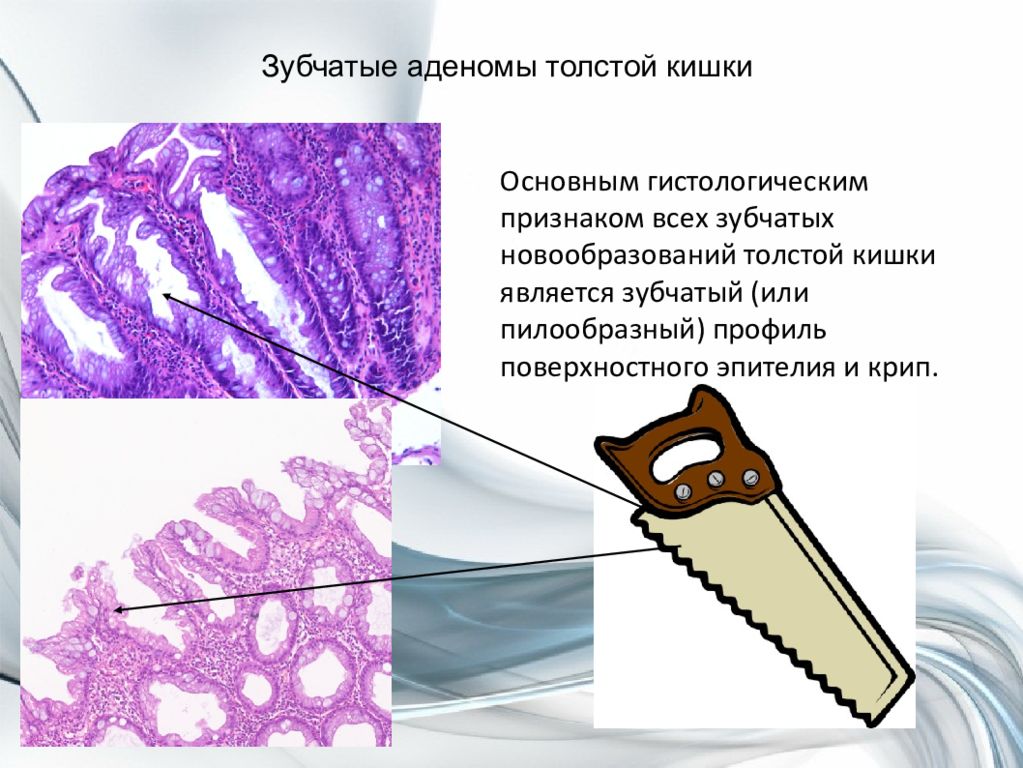 Зубчатое образование толстой