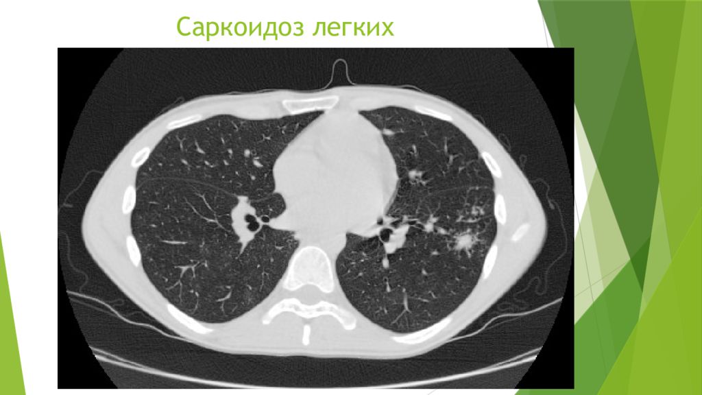 Саркоидоз легких что это. Легочно медиастинальная форма саркоидоза. Саркоидоз легочная форма на кт. Легочно-медиастинальная форма саркоидоза легких кт.