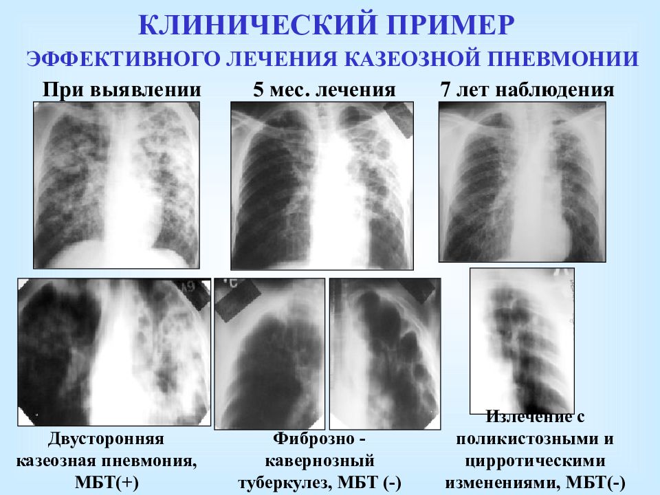 Клиническая картина при туберкулезе у детей