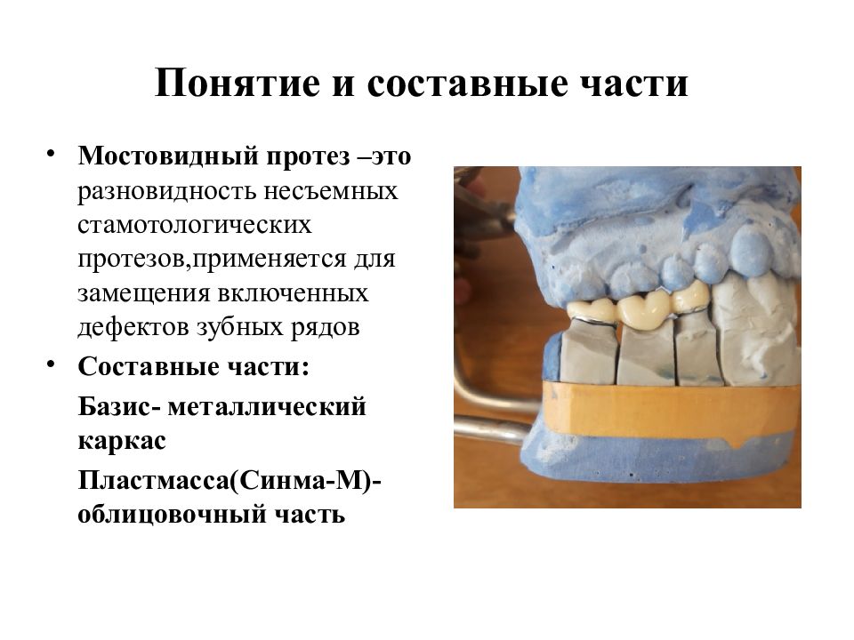 Изготовление цельнолитых протезов. Цельнолитого мостовидного протеза с облицовкой. Этапы изготовления цельнолитых мостовидных протезов. Этапы изготовления мостовидного протеза. Составные части мостовидного протеза.