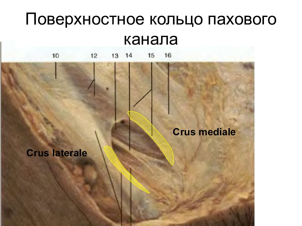 Поверхностное паховое. Поверхностное паховое кольцо анатомия. Поверхностное паховое кольцо стенки. Поверхностное кольцо пазового канал. Поверхностное кольцо gf[jdjujканала.