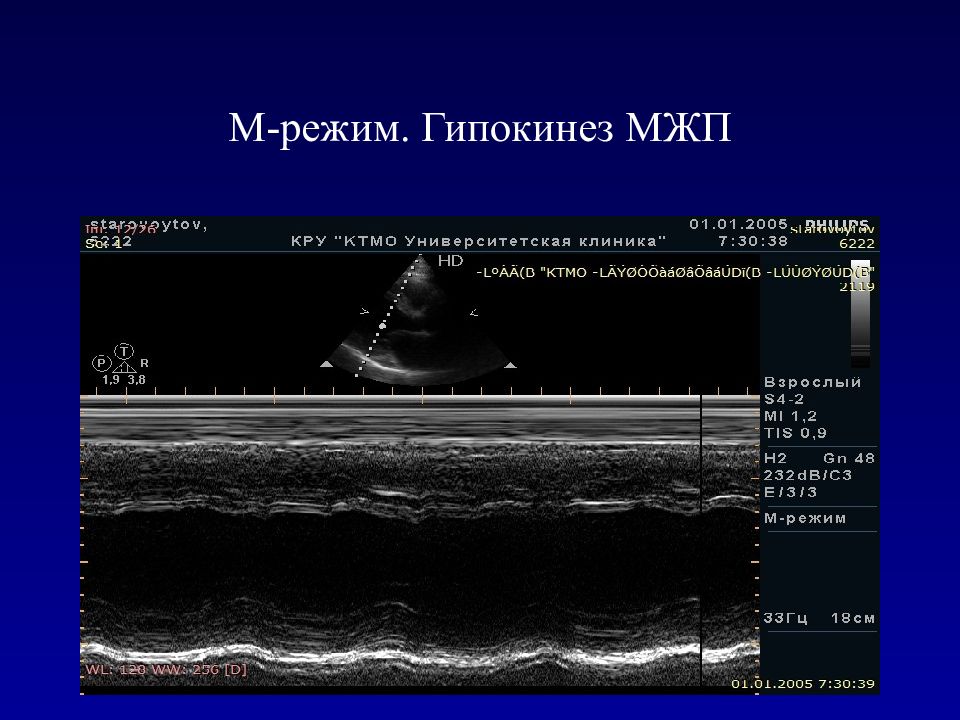 М режим. Диффузный гипокинез. Гипокинез. Диффузный гипокинез на фоне аритмии.