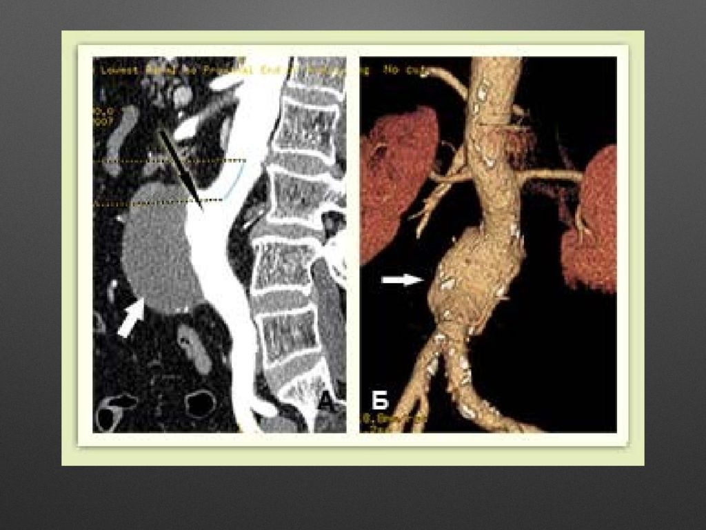 Склероз брюшной аорты. Аортография аневризма аорты. Аневризма брюшной аорты аортография. Расслаивающая аневризма брюшной аорты кт. Аневризма брюшной аорты рентгенография.