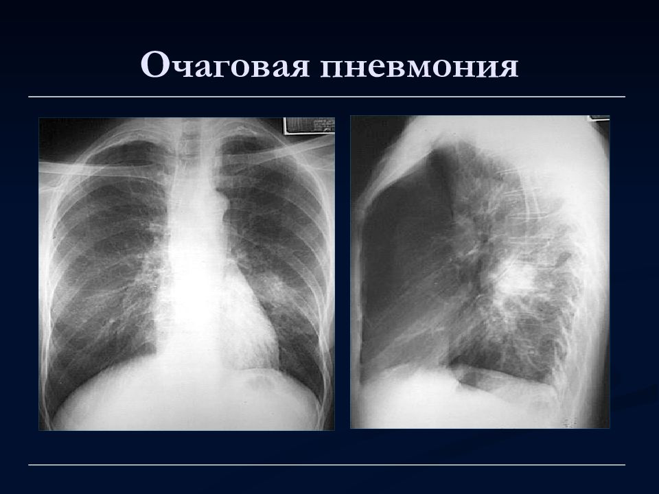 Плевропневмония симптомы. Очагово сливная пневмония рентген. Правосторонняя очаговая пневмония рентген. Очаговая пневмония рентген. Очагтвая пневмония на рентеге.