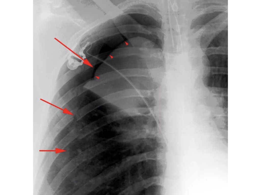 Разрыв легочной. Пневмоторакс рентген. Плащевидный пневмоторакс на рентгене. Спонтанный пневмоторакс рентген. Пневмоторакс лёгких рентген.