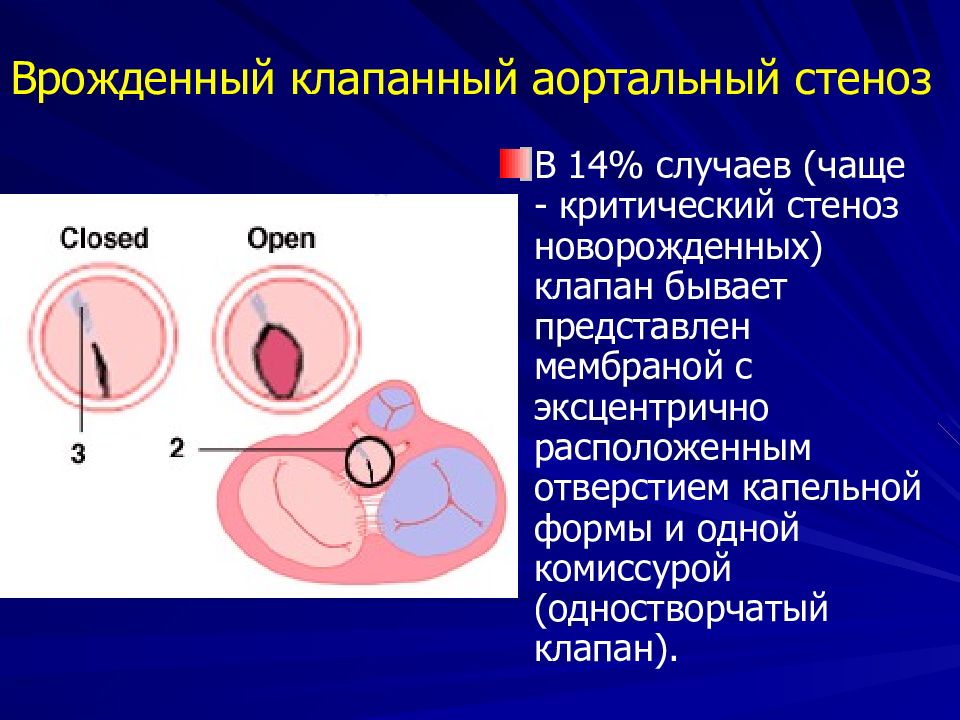 Аортальный клапан. Аортальный клапан 3 створчатый. Одностворчатый аортальный клапан. Анатомия аортального клапана. Врожденный клапанный аортальный стеноз.