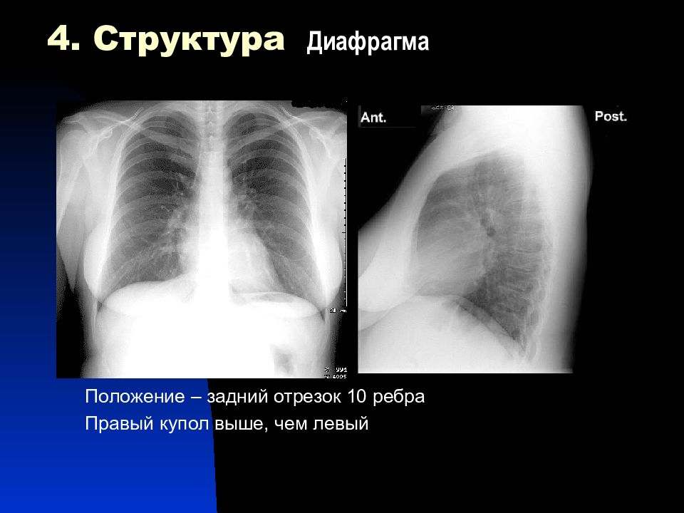 Диафрагмальная спайка. Рентгеноанатомия грудной клетки. Рентгеноанатомия органов дыхания. Положение правого купола диафрагмы. Рентгеноанатомия средостения.