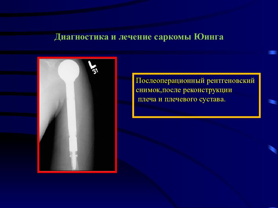 Диагностика опухоли кости. Саркома Юинга плечевой кости рентген. Саркома Юинга опухоль костей.