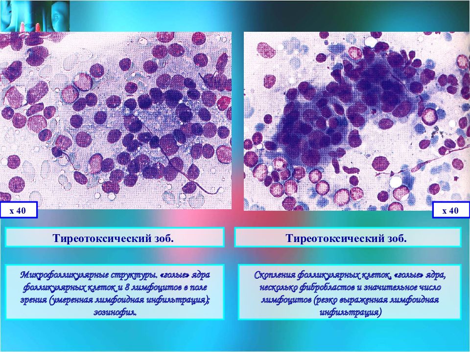 Цитологическая картина фолликулярной опухоли щитовидной железы что значит