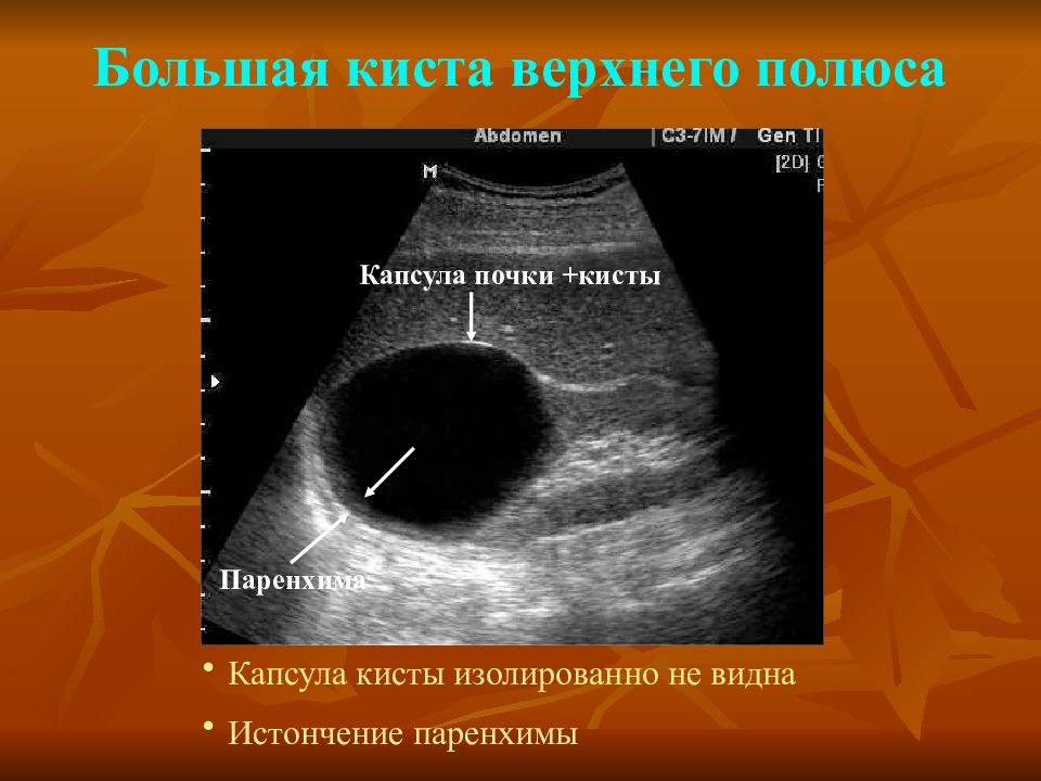 Паренхиматозная киста почки. Киста паренхимы почки УЗИ. Верхний полюс левой почки на УЗИ. Верхний полюс почки на УЗИ. Киста верхнего полюса правой почки.