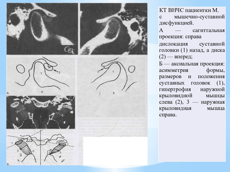 Схема патогенеза развития дисфункции внчс