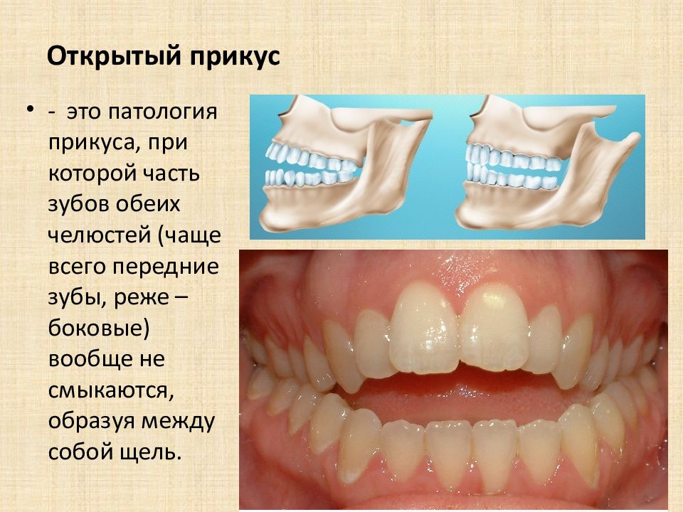 Открытый прикус. Зубы не смыкаются прикус. Боковой открытый прикус. Патологический прикус.