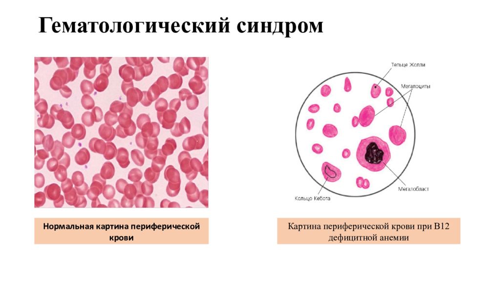 Синдром тельце. Периферическая кровь при в12 дефицитной анемии. В12 дефицитная анемия картина крови. В12 дефицитная анемия мазок крови. Картина периферической крови при в12 дефицитной анемии.