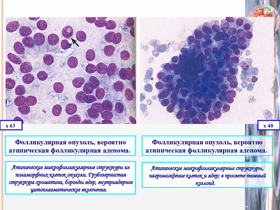 Щитовидная железа фолликулярные. Микрофолликулярная аденома. Фолликулярная аденома щитовидной железы цитология. Цитологическое исследование патанатомия. Цитологическая картина фолликулярной опухоли.