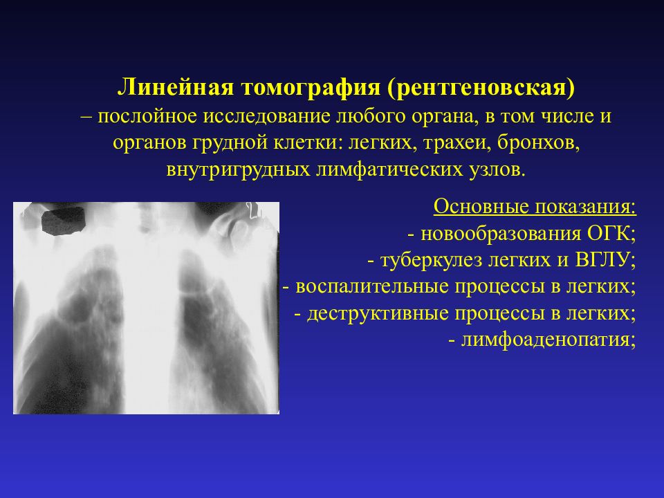 Туберкулез трахеи презентация