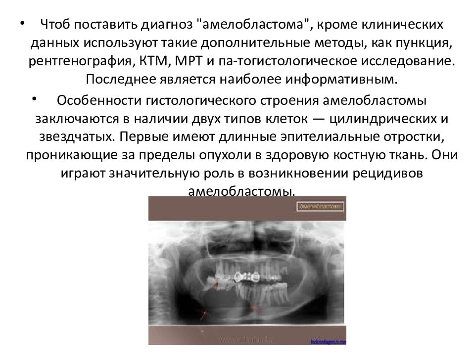 Клиническая картина сложной и составной одонтомы характеризуется