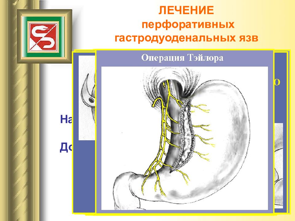 Возникновение сквозного дефекта в стенке полого органа