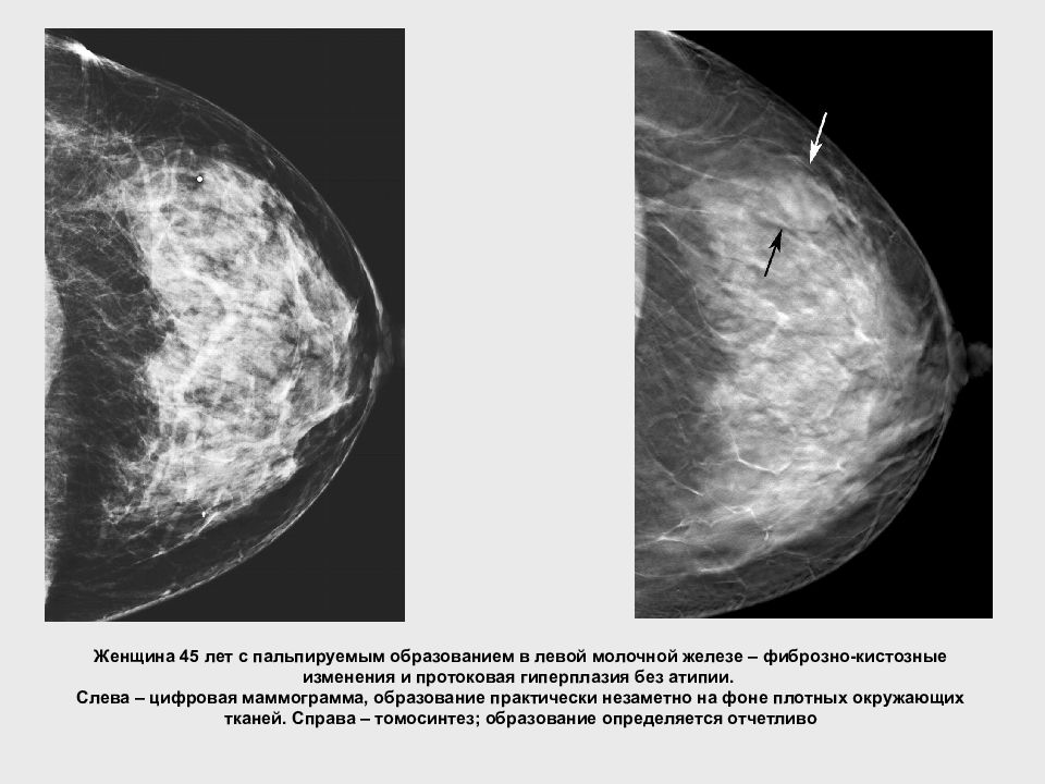 Признаки фиброзных изменений молочных. Фиброзная мастопатия маммограмма. Кистозная мастопатия маммография. Фиброзно кистозная мастопатия молочной железы УЗИ. Фиброзно-кистозная мастопатия рентген молочных желез.