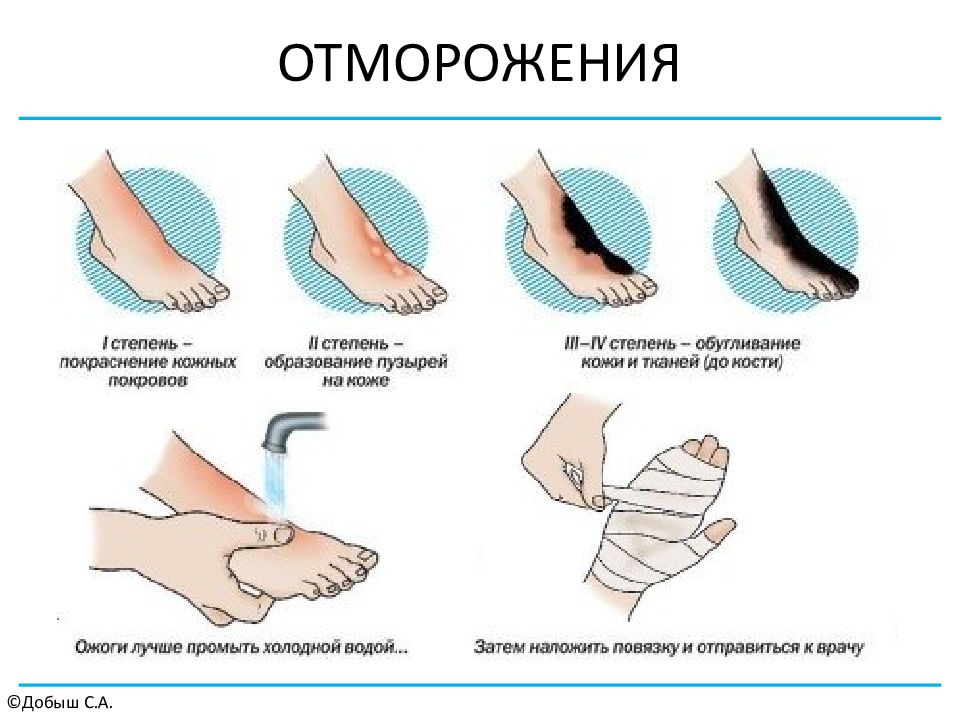 Холодовая травма картинки