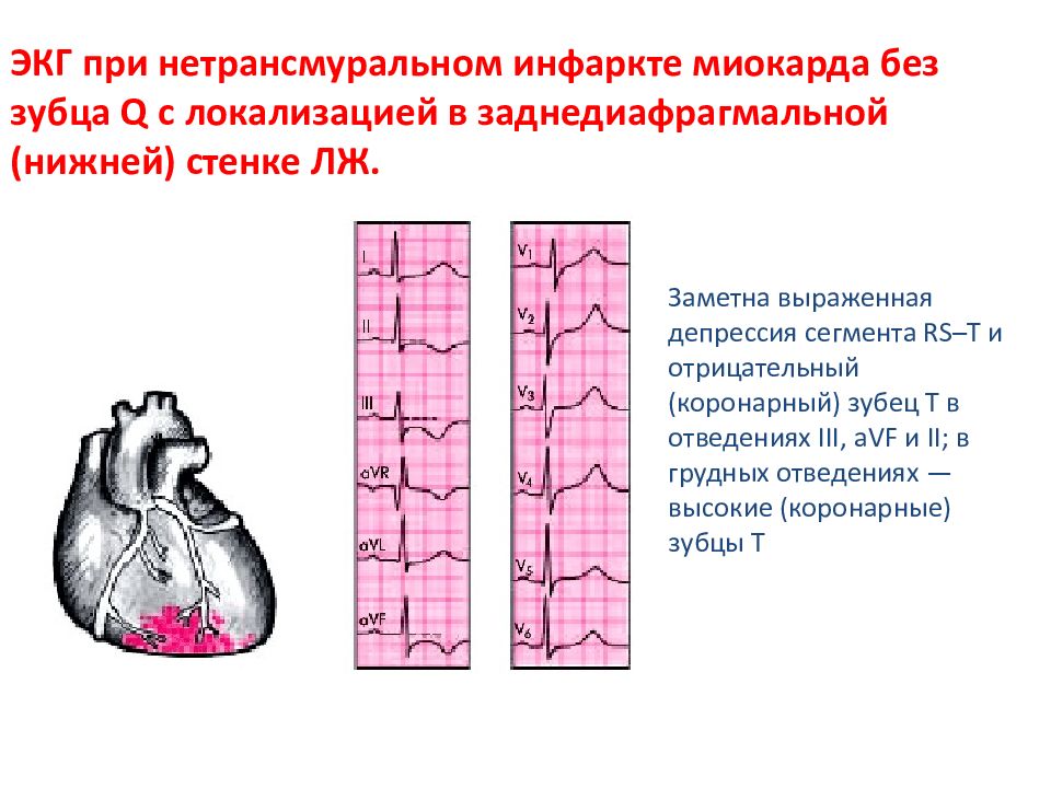 Признаки трансмурального инфаркта. ЭКГ при инфаркте миокарда нижней стенки. Инфаркт нижнедиафрагмальной локализации. ЭКГ при инфаркте без зубца q. Острый трансмуральный инфаркт нижней стенки миокарда ЭКГ.