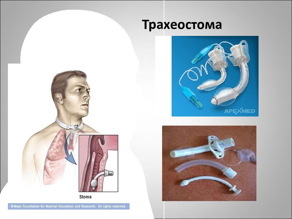 Ивл через трахеостому. Трахеопластома что такое. Трахеостома - Стома трахеи..